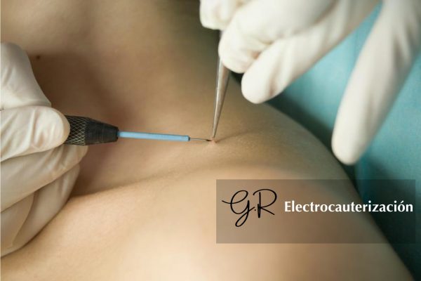 Electrocauterización – Guichell Electrocauterización - Guichell